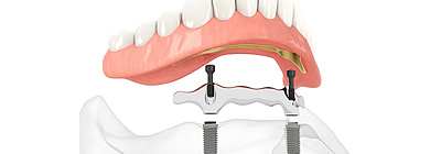 Stegprothese: Aufbau, Arten und Pflege des kombinierten Zahnersatzes