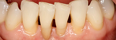 Wie kann man den Zahnfleischrückgang verhindern?