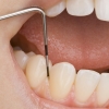 Súlyos következményei lehetnek a fogágybetegségnek
