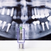 Mit érdemes tudni a fogászati implantátumokról?
