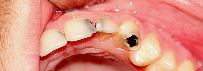 Durch kranke Zähne verursachte Beschwerden und was Sie dagegen tun können