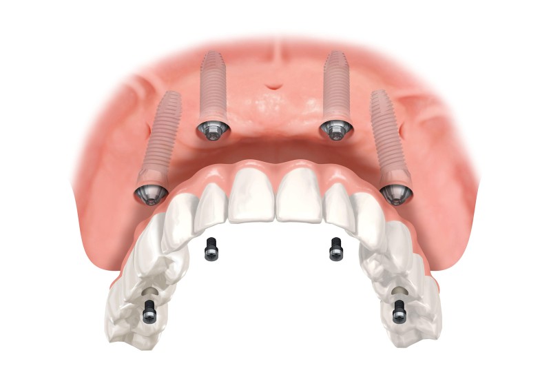 All On 4 Zahnersatz Bei Vollstandigem Zahnverlust