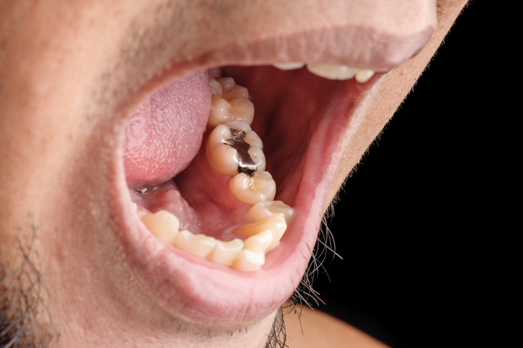 Kieferknochenentzündung nach zahn ziehen