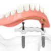 Stegprothese: Aufbau, Arten und Pflege des kombinierten Zahnersatzes