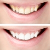 Bleaching - wirksame und anhaltende Zahnaufhellungsmethoden
