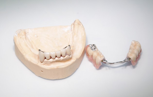 Kombinierter Zahnersatz