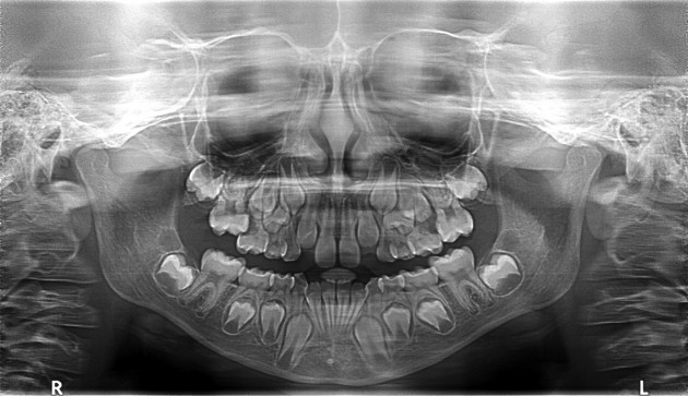 Zahnwechsel: Milchzähne werden durch bleibende Zähne herausgestoßen
