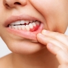 Parodontitis: Was Sie über die Zahnfleischentzündung wissen sollten