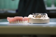 Kombinierter Zahnersatz: Stegprothese #1