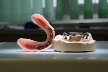 Kombinierter Zahnersatz: Stegprothese #2