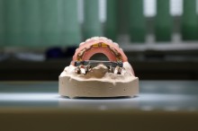 Kombinierter Zahnersatz: Stegprothese #3