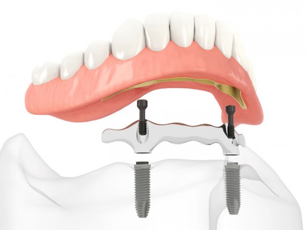 Stegreitende Deckprothese