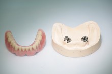 Kombinierter Zahnersatz: Teleskopprothese #1