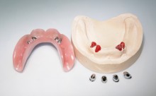 Kombinierter Zahnersatz: Teleskopprothese #2