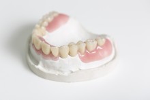 Kombinierter Zahnersatz: Teleskopprothese #3