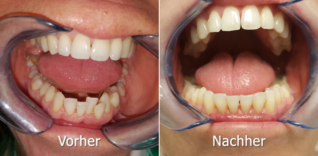 Unsichtbare Zahnspange Invisalign Gelencser Dental Magazin