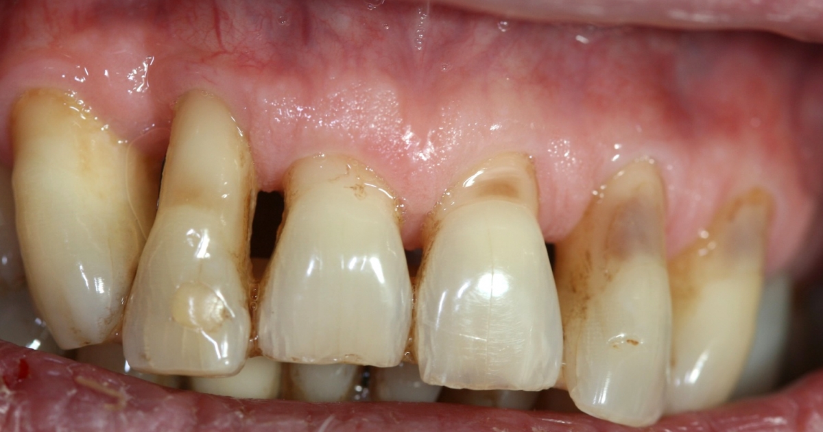 Zahnfleischrückgang verhindern: Alle Tipps und Tricks