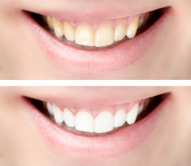 Das BEYOND Perl White-System bietet eine besonders effektive Methode, die innerhalb von nur 60 Minuten eine lang anhaltende Aufhellung bringt.