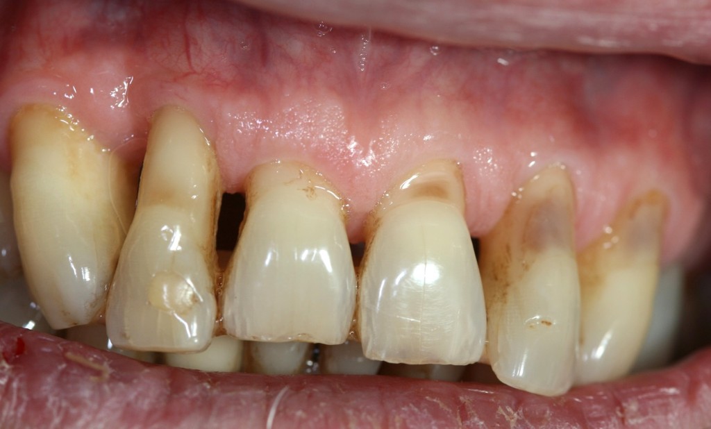 Mit schlechte 30 zähne Schlechte Zähne: