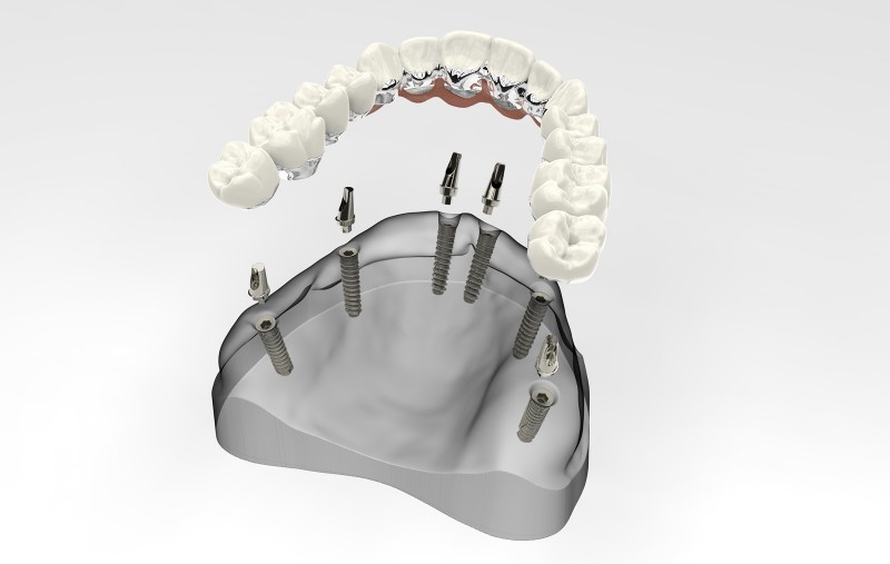 Sparpotenzial Zahnimplantat