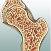 Zahnimplantation sogar bei Osteoporose