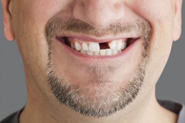 Die unvorteilhafte Optik führt auch zu fehlerhafter Zahnführung.