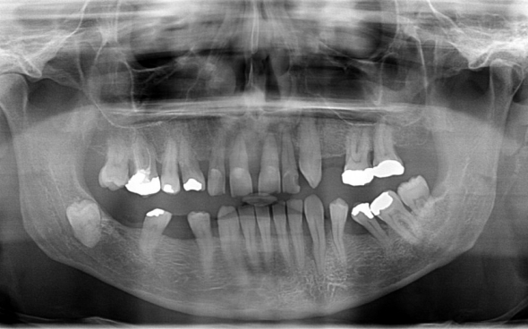 Für die Behandlungen inklusive Wurzelfüllungen und Vektorbehandlung wurden 10 Arbeitstage geplant mit insgesamt 7 Sitzungen.