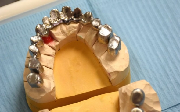 Modell nach der Bissnahme: Metallgerüst für den festsitzenden Zahnersatz.