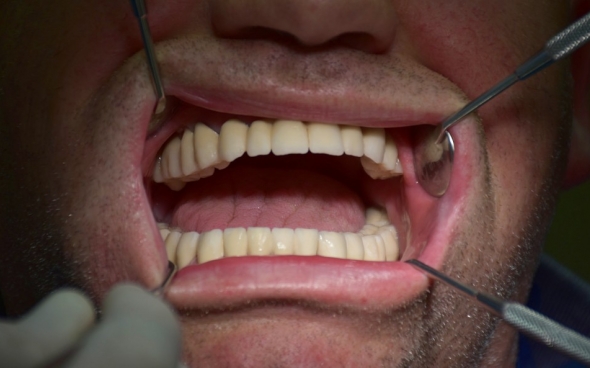 Festsitzende Vollbrücke mit insgesamt 25 Metallkeramikkronen