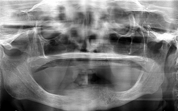 Geplant wurde eine Lokator-Prothese für den Unterkiefer, verankert auf 4 Implantaten. In der ersten Phase wurden die Implantate gesetzt, und nach einer Einheilzeit von 3 Monaten wurde der endgültige Zahnersatz fertiggestellt.