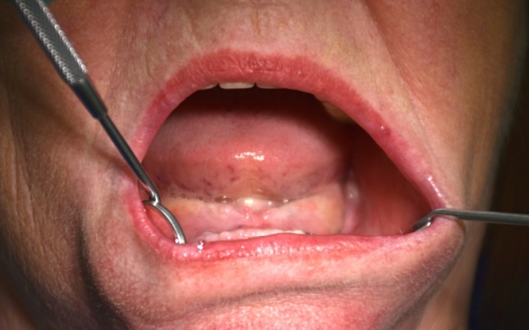 Zahnloser Unterkiefer mit den eingeheilten Implantatkörpern