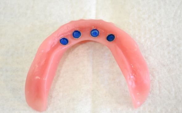 Auf der Innenseite der Unterkieferprothese sind die 4 Locator-Abutments zu sehen. Vier kleine Kunststoffkappen, mit denen die Prothese auf den Implantaten fixiert werden kann.