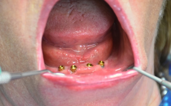 Das Gegenstück im Mund: die festgezogenen Locatoren.