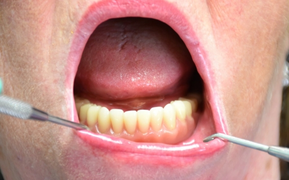 Die fertige Unterkieferprothese mit sicherer Halt auf vier Implantaten