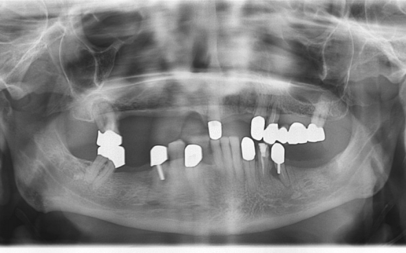 Als optimale Langzeitlösung wurden Teleskopprothesen geplant, sodass die erhaltungswürdigen Restzähne mit Teleskopkronen versehen worden sind.