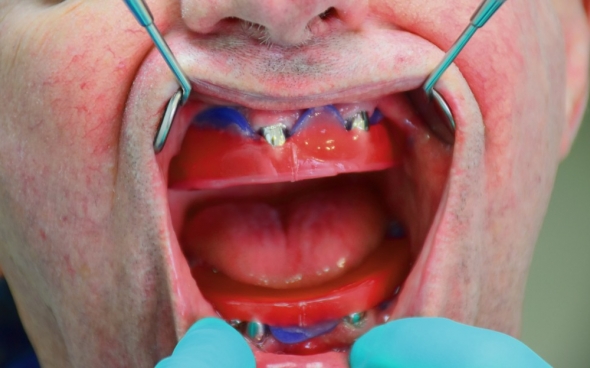 Bissregistration im Ober- und Unterkiefer mit Schablone. Dadrunter sind die Primärteile der Teleskopkronen zu sehen.