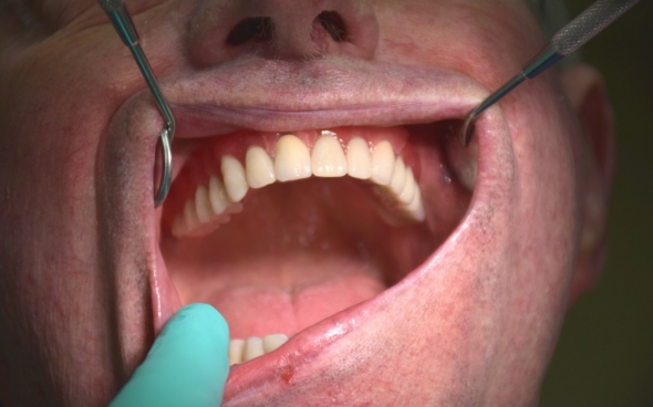 Wachsprobe Oberkiefer