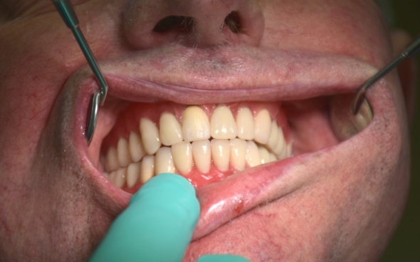 Zentralrelation Oberkiefer