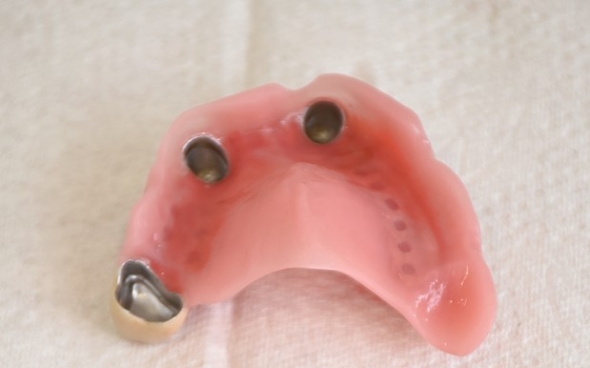 Basis vom fertigen Zahnersatz von unten