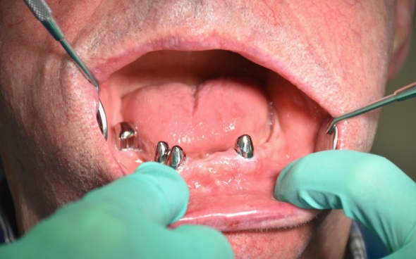 Einzementierte Primärkronen im Unterkiefer