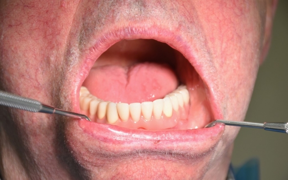 Fertige Teleskopprothese (Unterkiefer)