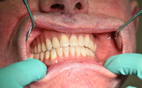 Neue Teleskopprothesen im Zentralokklusion